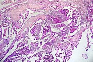 Papillary thyroid cancer, light micrograph