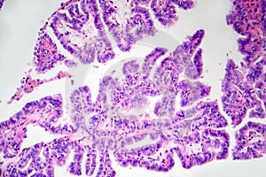 Papillary thyroid cancer, light micrograph