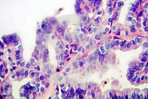 Papillary thyroid cancer, light micrograph