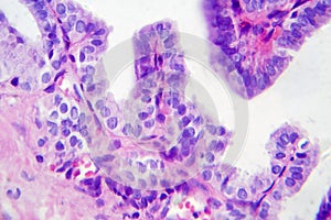 Papillary thyroid cancer, light micrograph