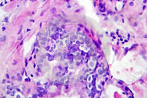 Papillary thyroid cancer, light micrograph