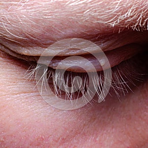 Papilloma on the human eye close-up