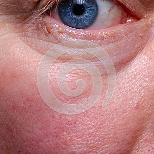 Papilloma on the human eye closeup