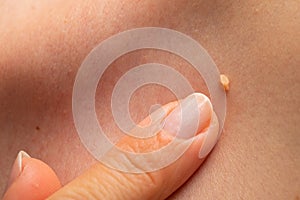Papilloma on human skin