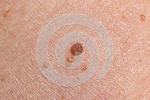 Papilloma on human skin - benign tumor in the form of mole, nevus Papillomatosis medicine