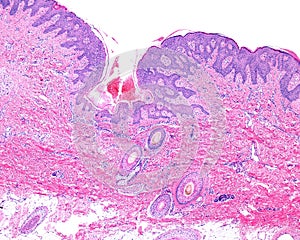 Human skin. Papilloma photo
