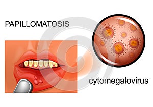 Papillomatosis of the oral mucosa photo