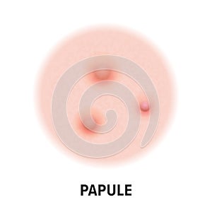 Papule skin acne type vector icon. Skin disease acne papule pimples type, face pore comedones