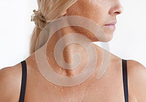 Papules mesotherapy on the face, neck and dÃÂ©colletÃÂ©.