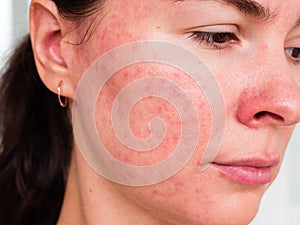 Papulopustular rosacea, the patient`s cheek - the consequences of prolonged wearing of a mask