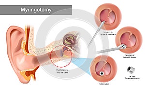 Paracentesis or myringotomy. Incision into tympanic membrane. Surgical procedure involving puncture of the tympanic photo