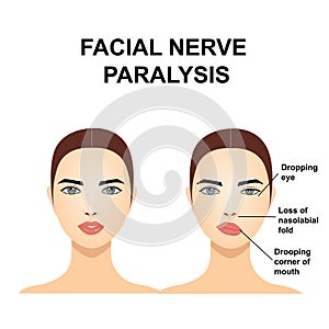 Paralysis of the facial nerve. Bell`s palsy