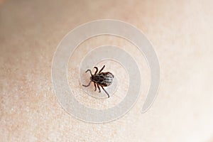 The parasite mite sits on a personâ€™s skin. infection carrier. Ixodes ricinus