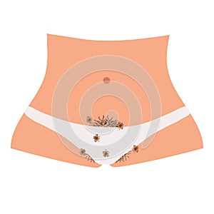 Parasitic diseases of Phthiriasis. Pediculosis pubis. Pubic lice structure. Sexually transmitted diseases. Infographics