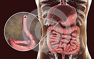 Parasitic hookworm Ancylosoma duodenale in human duodenum