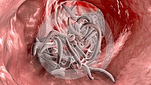 Parasitic worms in the lumen of intestine