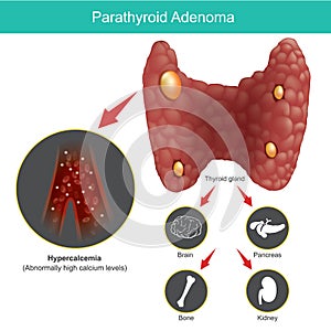 Parathyroid Adenoma. Illustration. photo