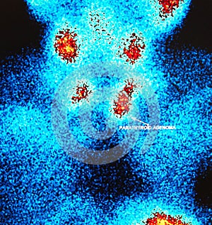 Parathyroid adenoma ,nuclear medicine