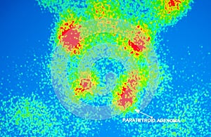 Ghiandole paratiroidi  nucleare 