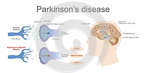 Parkinson`s Affected neuron. Health care education infographic.