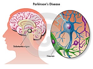Parkinson's disease photo