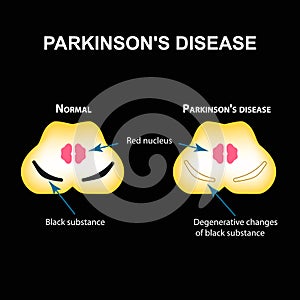 Parkinson`s disease. Degenerative changes in the brain are a black substance. Vector illustration on black background. photo