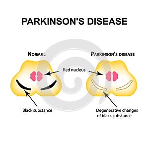 Parkinson`s disease. Degenerative changes in the brain are a black substance. Vector illustration on isolated background. photo