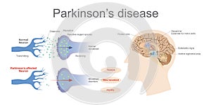 Parkinson`s Affected neuron. Health care education infographic. photo