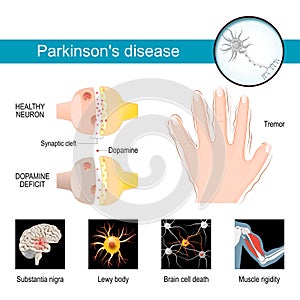 Parkinson`s disease Infographic. Symptoms of a parkinsonism photo