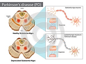 Parkinson s disease. Normal and Depreciated Substantia Nigra