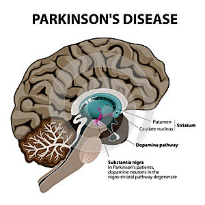 Parkinsons Disease photo