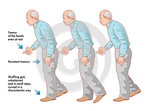 Parkinsons disease photo