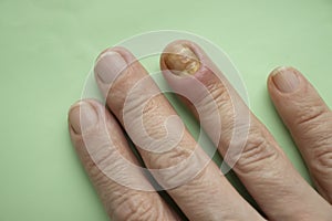 Paronychia disease of the fingernail sensation  skin  aches  redness  disease painful  healing  painful  problem photo