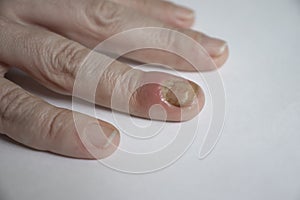 Paronychia disease of the fingernail  aches  redness  disease painful  healing  painful  problem photo