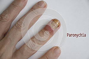 Paronychia disease of the fingernail  painful  healing  painful  problem photo
