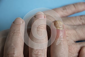 Paronychia disease of the fingernail healing  painful  problem photo