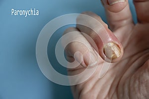 Paronychia disease of the fingernail bacteria  painful  problem photo