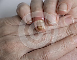 Paronychia disease of the fingernail disease painful  healing  painful  problem photo