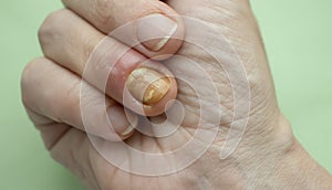 Paronychia disease of the fingernail infection skin  aches  redness  disease painful  healing  painful  problem photo