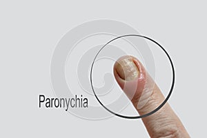 Paronychia disease of the fingernail symptom    skin  aches  redness  disease painful  healing  painful  problem photo