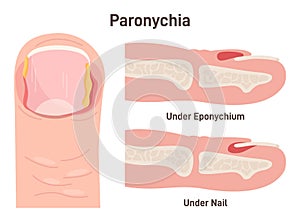 Paronychia. Nail disease, inflammation of the skin around the nail.