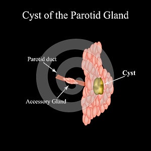 Parotid salivary gland cyst. The structure of the parotid salivary gland. Vector illustration on isolated background photo