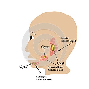 Parotid salivary gland. Submandibular salivary gland. Sublingual salivary gland. cyst. Vector illustration on isolated photo