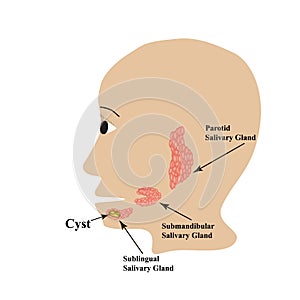 Parotid salivary gland. Submandibular salivary gland. Sublingual salivary gland. cyst. Vector illustration on isolated photo