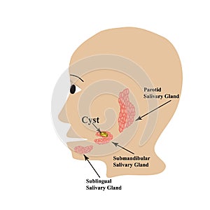 Parotid salivary gland. Submandibular salivary gland. Sublingual salivary gland. cyst. Vector illustration on isolated photo