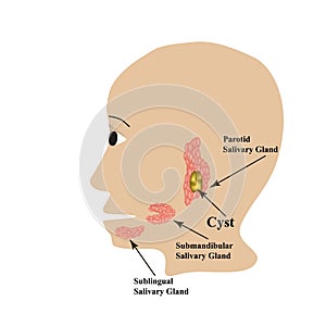 Parotid salivary gland. Submandibular salivary gland. Sublingual salivary gland. cyst. Vector illustration on isolated photo