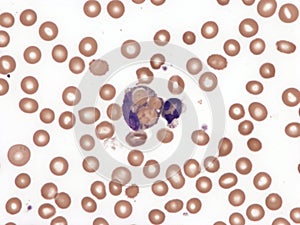 Paroxysmal cold hemoglobinuria.