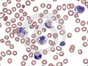 Paroxysmal cold hemoglobinuria.