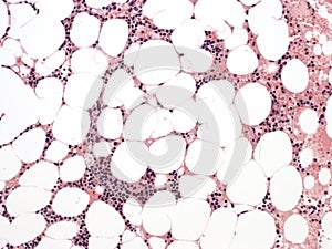 Paroxysmal nocturnal hemoglobinuria. Bone marrow.