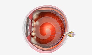 Pars planitis is an eye disease where the middle layer of the eye, called the uvea, becomes inflamed